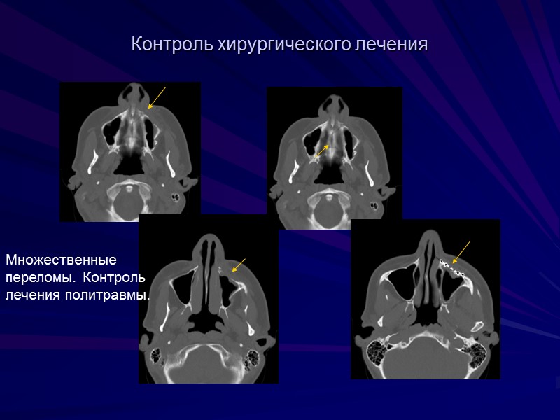Контроль хирургического лечения Множественные переломы. Контроль лечения политравмы.